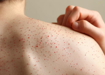 Diferencias entre sarampión y varicela: Síntomas, Formas de contagio y Vacunación