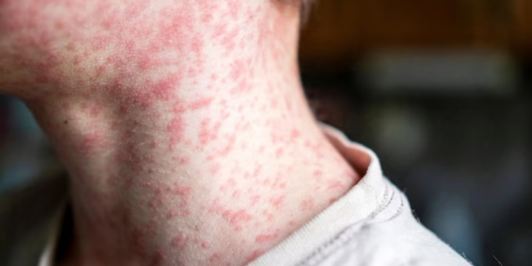 Sarampión en México supera los 9000 casos acumulados