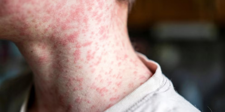 Sarampión en México: ¿Cuántos casos confirmados se registran hoy 21 de febrero?