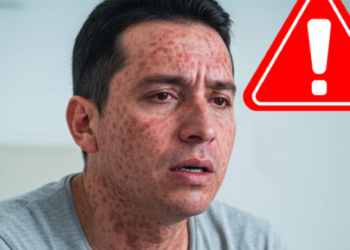 Más contagioso que el Covid-19: ¿Qué tan peligroso es el sarampión? El riesgo de un virus que “borra” la memoria inmunológica