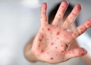 Suman 32 muertes por sarampión; ¿Qué estados reportan más casos?