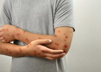 Sarampión en México, expertos alertan por Mundial 2026 y refuerzan llamado a vacunación