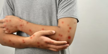 Sarampión en México, expertos alertan por Mundial 2026 y refuerzan llamado a vacunación