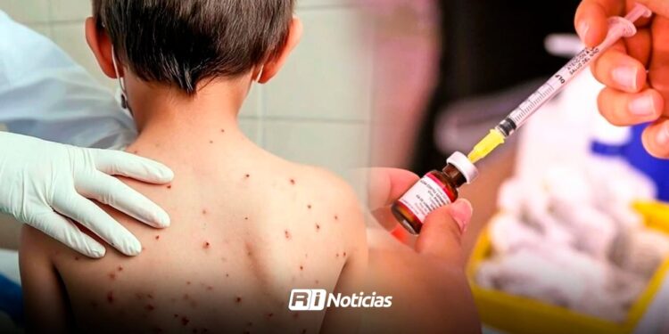 Sinaloa ocupa el sexto lugar nacional en casos de sarampión; reporta 100 contagios en 2026