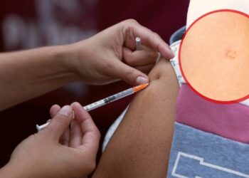 ¿La vacuna contra el sarampión deja marca en el brazo?