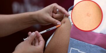 ¿La vacuna contra el sarampión deja marca en el brazo?