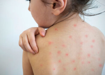 ¿Cuáles son los estados con más contagios de sarampión en México? Estas son las formas de prevenirte