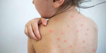 ¿Cuáles son los estados con más contagios de sarampión en México? Estas son las formas de prevenirte