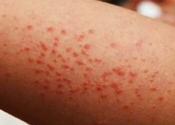 Brote de sarampión en México: ¿cuántos casos y defunciones suman?