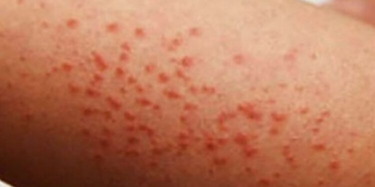 Brote de sarampión en México: ¿cuántos casos y defunciones suman?