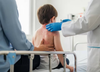 Sarampión en México hoy domingo 15 de marzo: ¿Qué estado encabeza los casos acumulados y Cuál es el grupo más afectado?