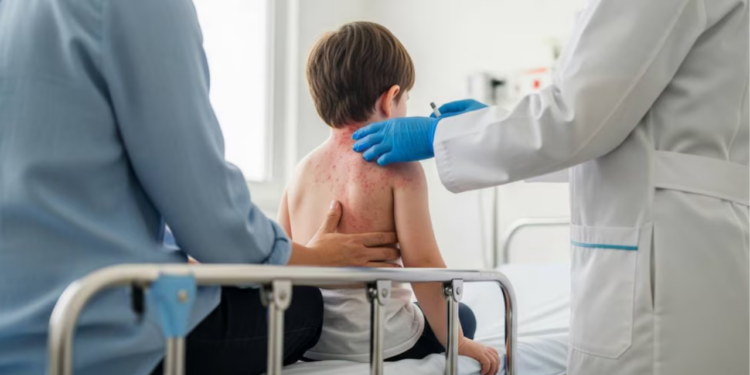 Sarampión en México hoy domingo 15 de marzo: ¿Qué estado encabeza los casos acumulados y Cuál es el grupo más afectado?