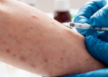 México rebasa los 13 mil casos confirmados de sarampión