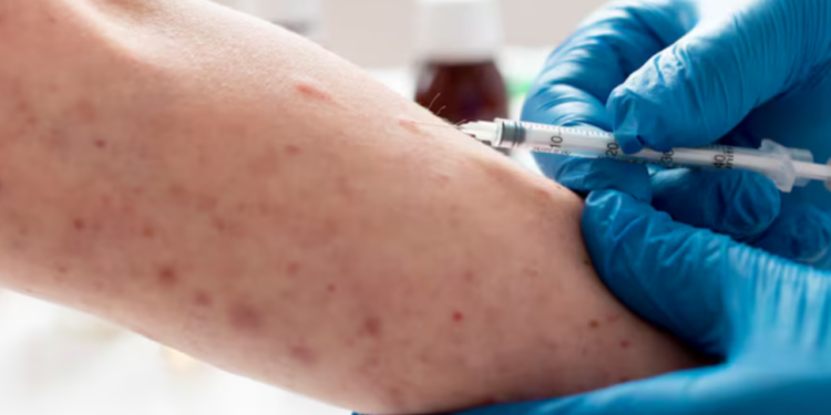 México rebasa los 13 mil casos confirmados de sarampión