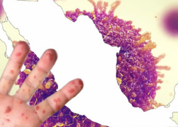 México, el país más afectado por el sarampión en América