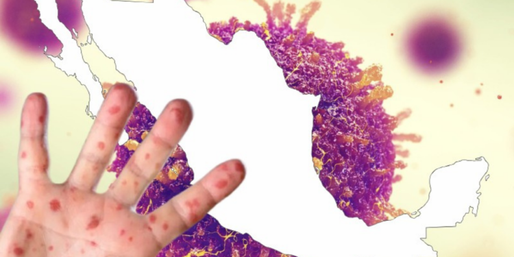 México, el país más afectado por el sarampión en América