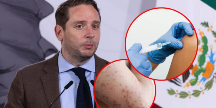 Casos activos de sarampión bajan 30% en México; Salud llama a no bajar la guardia y continuar vacunación