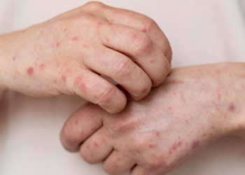 Casos de sarampión en México durante 2026 ya superan el total del año pasado