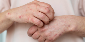 Casos de sarampión en México durante 2026 ya superan el total del año pasado