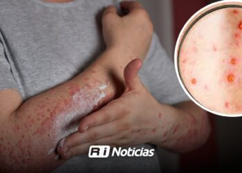 Alerta en Sinaloa por Sarampión: un caso de sarampión puede contagiar hasta a 16 personas