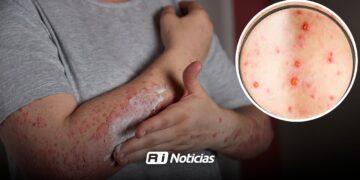 Alerta en Sinaloa por Sarampión: un caso de sarampión puede contagiar hasta a 16 personas