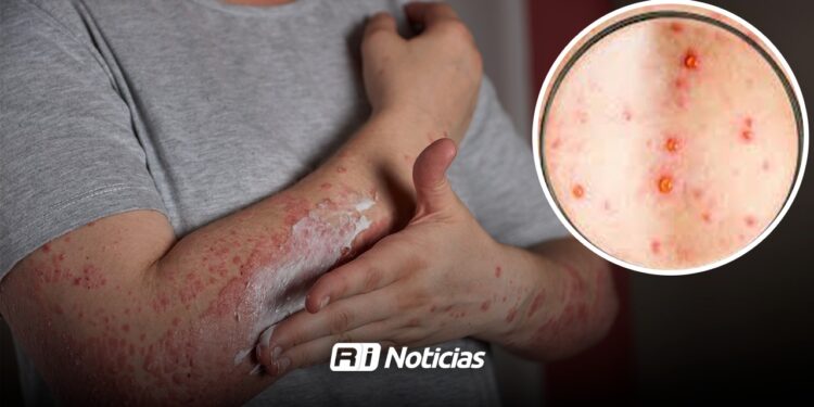 Alerta en Sinaloa por Sarampión: un caso de sarampión puede contagiar hasta a 16 personas