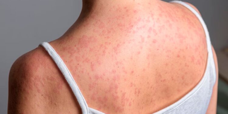 Sinaloa ocupa el cuarto lugar nacional en contagios de sarampión con 210 casos registrados