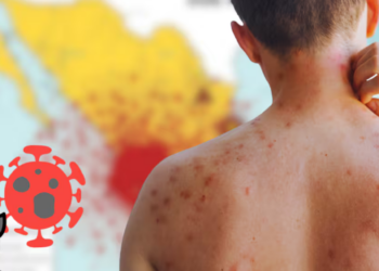 Casos de sarampión en lo que va de 2026 superan los de todo 2025