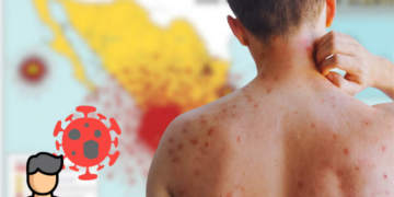 Casos de sarampión en lo que va de 2026 superan los de todo 2025